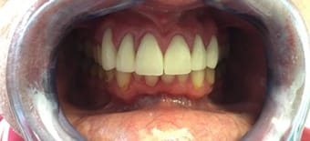 After Smile Makeover Treatment Reading Smiles