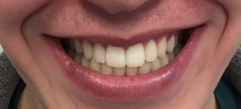 After Smile Makeover Treatment Reading Smiles