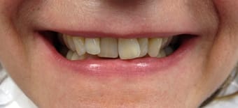 Before Smile Makeover Treatment Reading Smiles