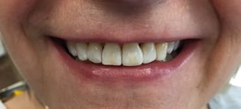 After Smile Makeover Treatment Reading Smiles