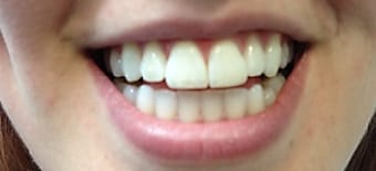 After cosmetic Treatment Reading Smiles
