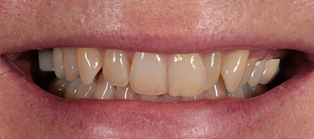 Before & after cosmetic bonding