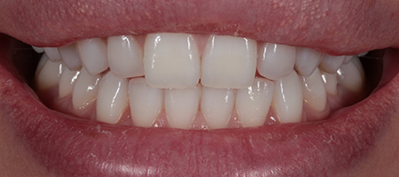 Before & after cosmetic bonding