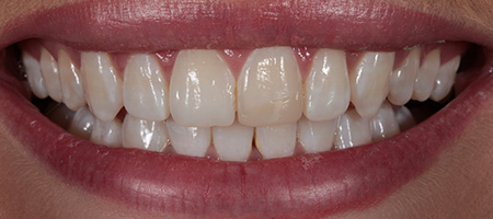 Before & after cosmetic bonding