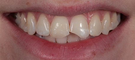 Before & after cosmetic bonding