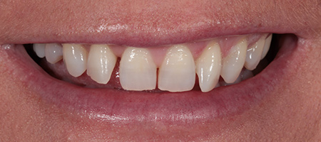 Before & after cosmetic bonding