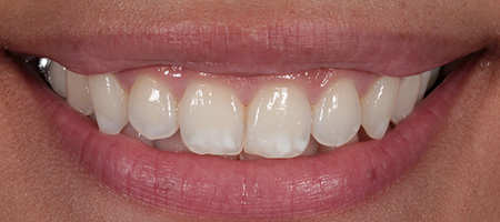 Before & after cosmetic bonding