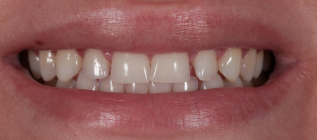 Before & after cosmetic bonding