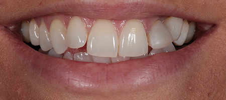 Before & after cosmetic bonding