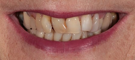 Before & after cosmetic bonding