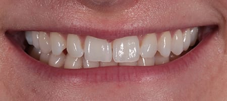 Before & after cosmetic bonding