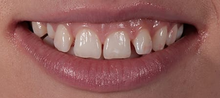 Before & after cosmetic bonding