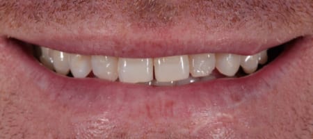 Before & after cosmetic bonding