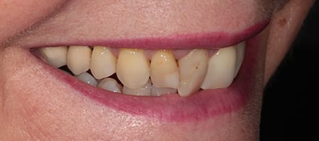 Before & after cosmetic bonding