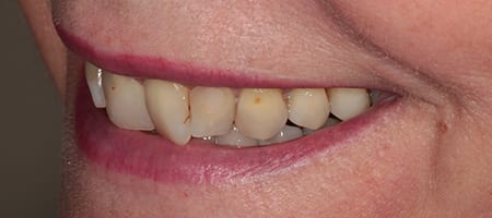 Before & after cosmetic bonding