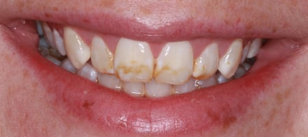 Before & after cosmetic bonding