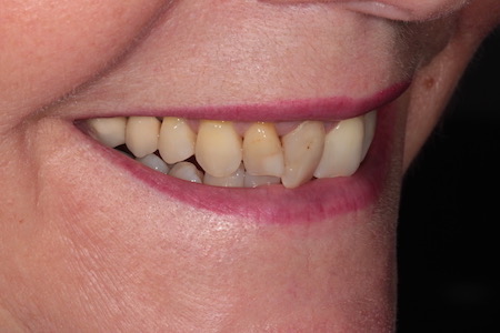 Before Smile Makeover Treatment Reading Smiles