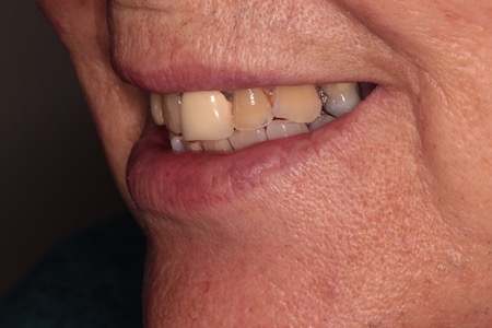 Before Smile Makeover Treatment Reading Smiles