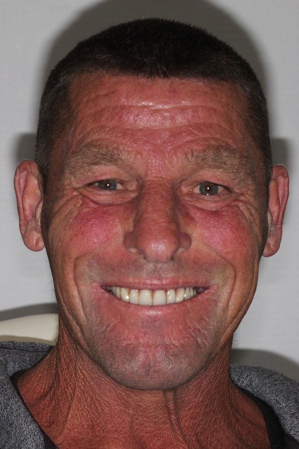 After Invisalign Treatment Reading Smiles