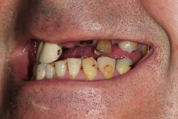 Before Invisalign Treatment Reading Smiles