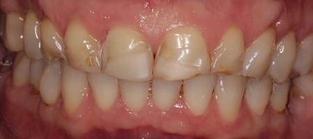 Before Smile Makeover Treatment Reading Smiles