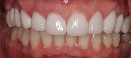 After Smile Makeover Treatment Reading Smiles