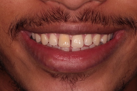 Before and After Invisalign Treatment Kingston