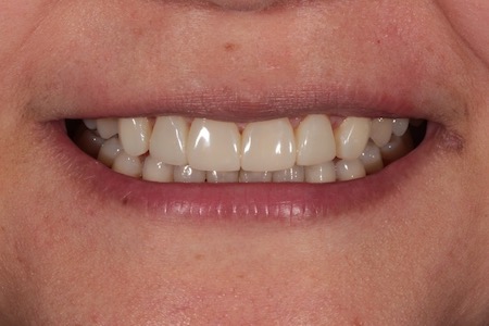 Before and After Invisalign Treatment Kingston