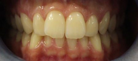 Before Invisalign Treatment Smile Rooms Glasgow