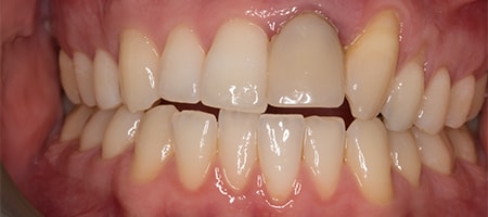 Before Smile Makeover Treatment Reading Smiles
