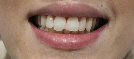 Before Smile Makeover Treatment Reading Smiles