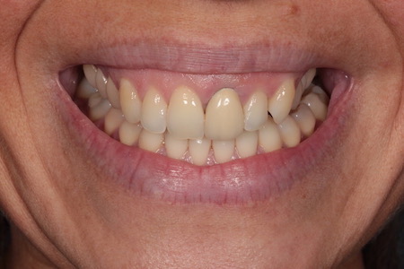 Before Smile Makeover Treatment Reading Smiles