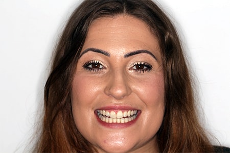 After Invisalign Treatment Reading Smiles