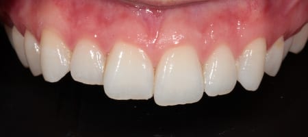 Before & after cosmetic bonding