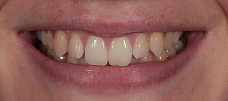 Before & after cosmetic bonding